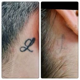 Laserpro Tattoo Removal gallery image 2
