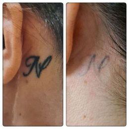 Laserpro Tattoo Removal gallery image 1