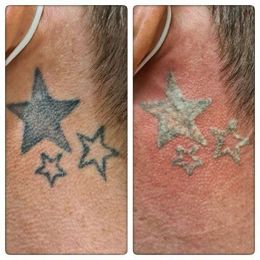 Laserpro Tattoo Removal gallery image 3