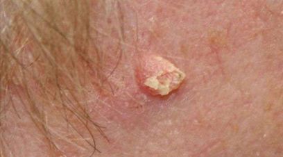 Skin Cancer Clinic Port Macquarie gallery image 14