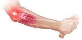 Signs of Tennis Elbow 