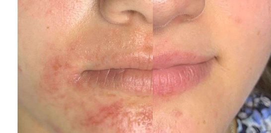 Before and After Reactive Skin 