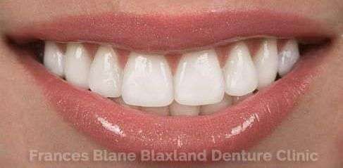 Beautiful Looking Denture Teeth
